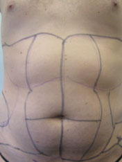 Before MicroTight™ results - front view