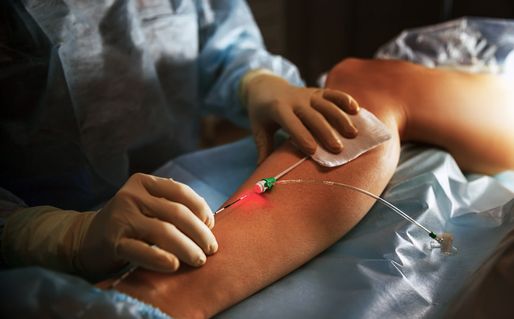 Doctor performing an Evla treatment