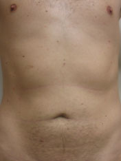After MicroTight™ results - front view
